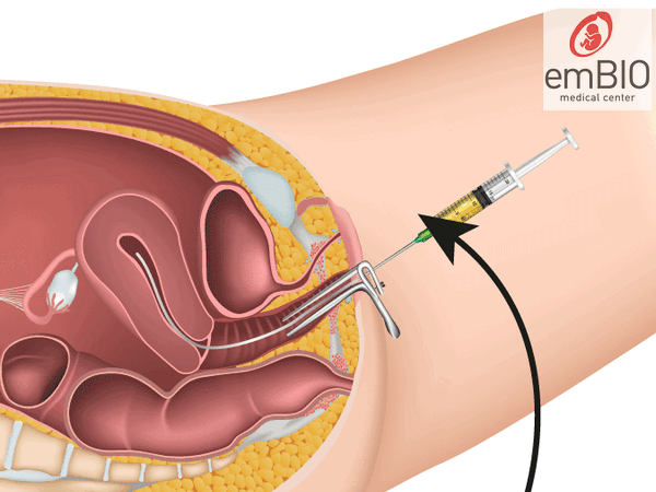 intrauterine insemination iui