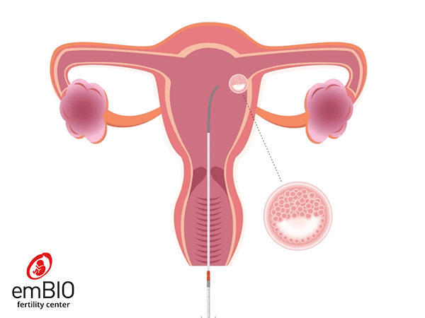 embryo transfer into the uterus