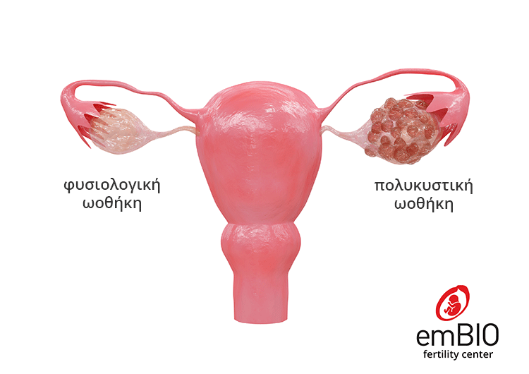 πολυκυστικες ωοθηκες