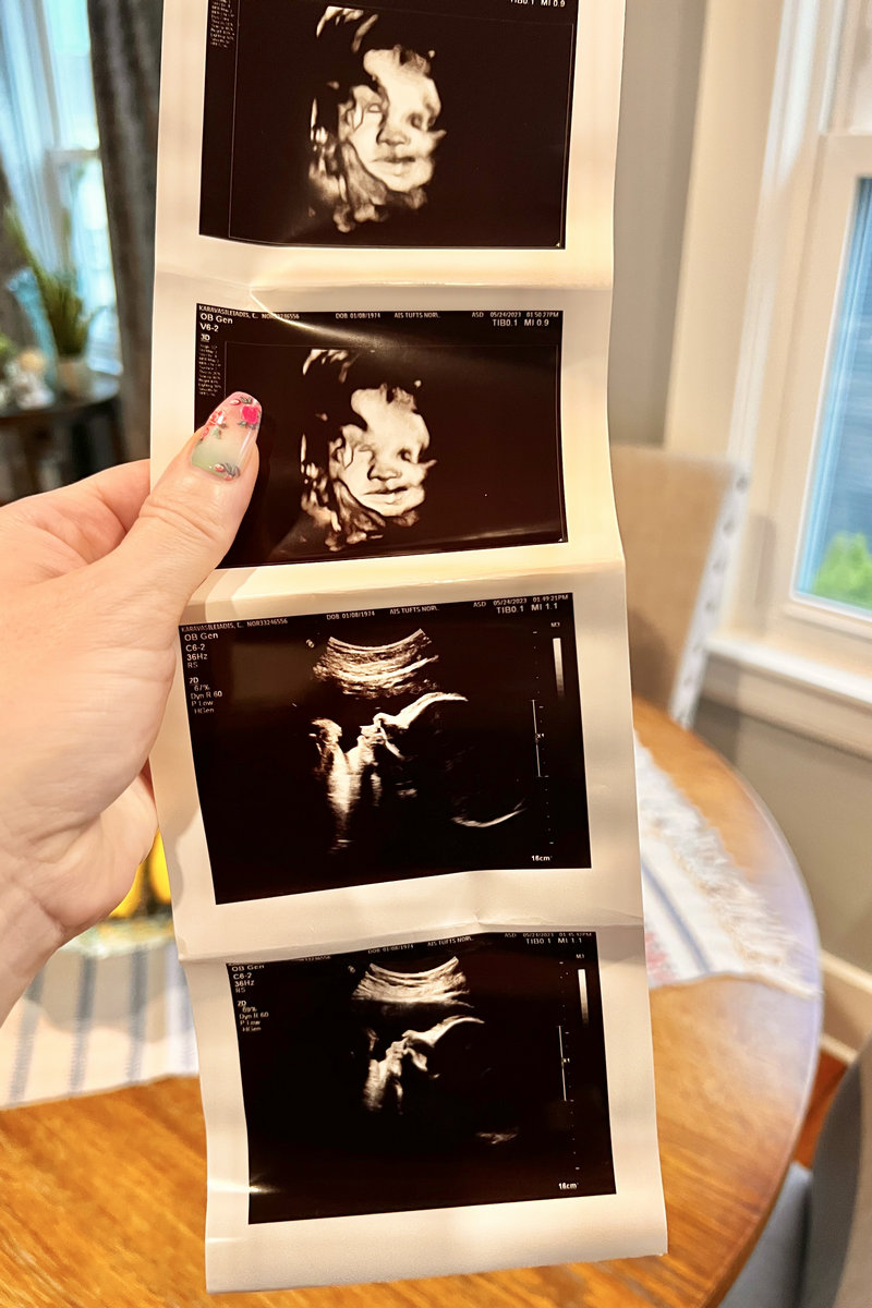 ultrazvuk trudnoće