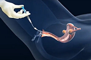 mock embryo transfer