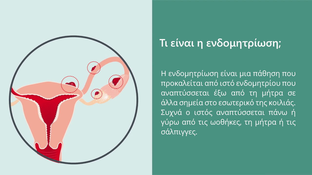 ενδομητριωση