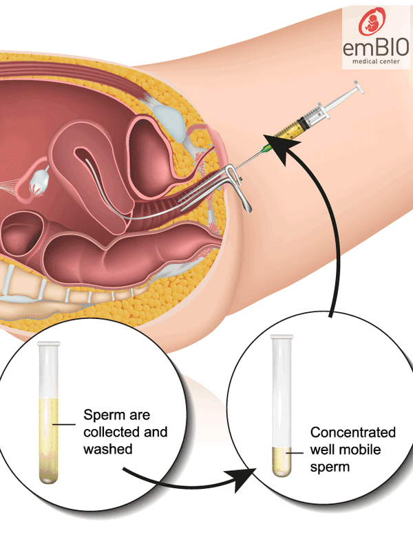 inseminare intrauterină