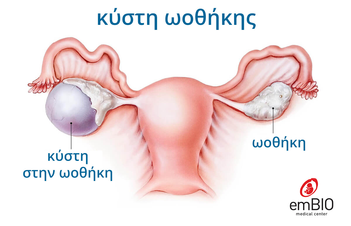 κυστη στην ωοθηκη