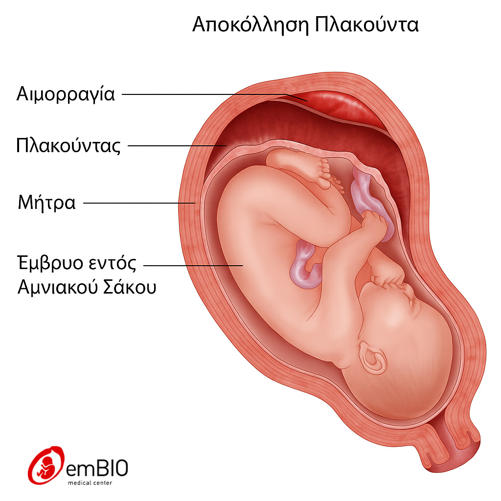 αποκόλληση πλακούντα