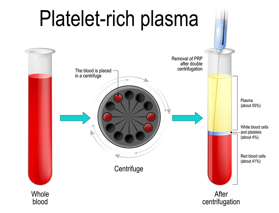 PRP-Plasma