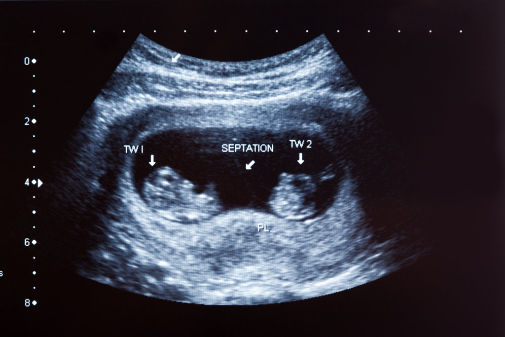 ultrasound of twin pregnancy