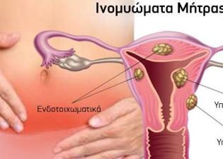 ινομύωμα που υπερβαίνει τα πέντε εκατοστά καλό είναι να αφαιρείται, ανεξάρτητα από το αν προκαλεί συμπτώματα.