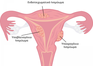 τύποι ινομυωμάτων μήτρας