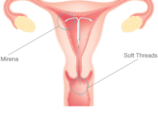 ενδομητριο σπιραλ μιρενα