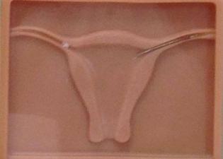 IVF, Fertility Treatment