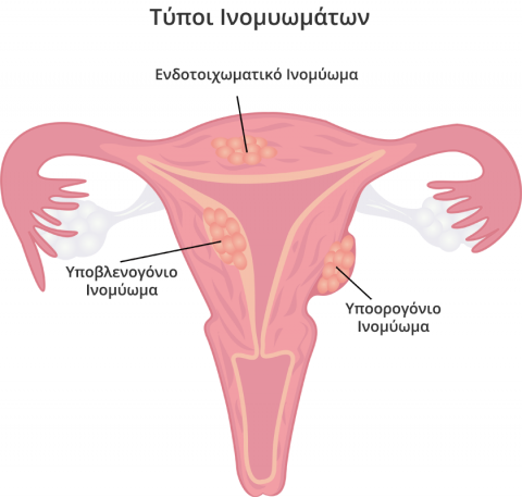 τύποι ινομυωμάτων μήτρας